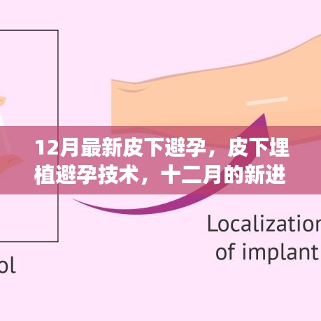 皮下埋植避孕技术最新进展及其影响分析