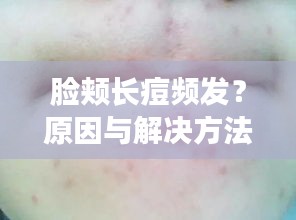 脸颊长痘频发？原因与解决方法大解析！