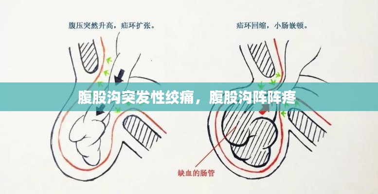 腹股沟突发性绞痛，腹股沟阵阵疼 