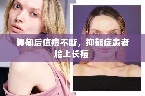 抑郁后痘痘不断，抑郁症患者脸上长痘 