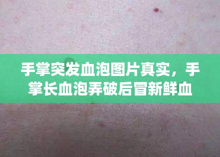 手掌突发血泡图片真实，手掌长血泡弄破后冒新鲜血 