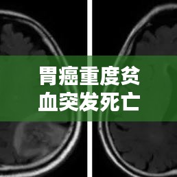 胃癌重度贫血突发死亡，警示与应对策略